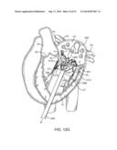 PROSTHETIC VALVE WITH ANTI-PIVOTING MECHANISM diagram and image