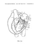 PROSTHETIC VALVE WITH ANTI-PIVOTING MECHANISM diagram and image