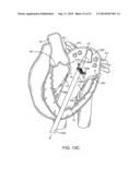 PROSTHETIC VALVE WITH ANTI-PIVOTING MECHANISM diagram and image