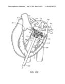 PROSTHETIC VALVE WITH ANTI-PIVOTING MECHANISM diagram and image