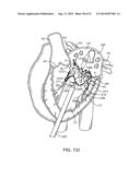 PROSTHETIC VALVE WITH ANTI-PIVOTING MECHANISM diagram and image