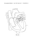 PROSTHETIC VALVE WITH ANTI-PIVOTING MECHANISM diagram and image