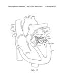 PROSTHETIC VALVE WITH ANTI-PIVOTING MECHANISM diagram and image