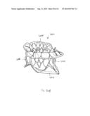 PROSTHETIC VALVE WITH ANTI-PIVOTING MECHANISM diagram and image