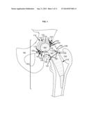 ARTIFICIAL JOINT COMPONENTS INCLUDING MECHANIZED SYNOVIAL FLUID DEFLECTING     STRUCTURES AND PARTICLE RETAINING STRUCTURES diagram and image