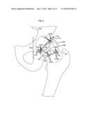 ARTIFICIAL JOINT COMPONENTS INCLUDING MECHANIZED SYNOVIAL FLUID DEFLECTING     STRUCTURES AND PARTICLE RETAINING STRUCTURES diagram and image