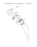 ARTIFICIAL JOINT COMPONENTS INCLUDING MECHANIZED SYNOVIAL FLUID DEFLECTING     STRUCTURES AND PARTICLE RETAINING STRUCTURES diagram and image