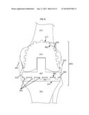 ARTIFICIAL JOINT COMPONENTS INCLUDING MECHANIZED SYNOVIAL FLUID DEFLECTING     STRUCTURES AND PARTICLE RETAINING STRUCTURES diagram and image