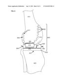 ARTIFICIAL JOINT COMPONENTS INCLUDING MECHANIZED SYNOVIAL FLUID DEFLECTING     STRUCTURES AND PARTICLE RETAINING STRUCTURES diagram and image