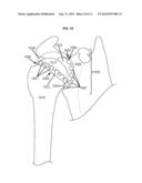 ARTIFICIAL JOINT COMPONENTS INCLUDING MECHANIZED SYNOVIAL FLUID DEFLECTING     STRUCTURES AND PARTICLE RETAINING STRUCTURES diagram and image