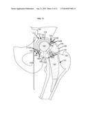 ARTIFICIAL JOINT COMPONENTS INCLUDING MECHANIZED SYNOVIAL FLUID DEFLECTING     STRUCTURES AND PARTICLE RETAINING STRUCTURES diagram and image