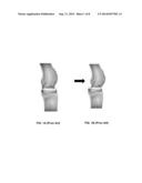 ANTERIOR STABILIZED PCL RETAINING TOTAL KNEE PROSTHESIS diagram and image