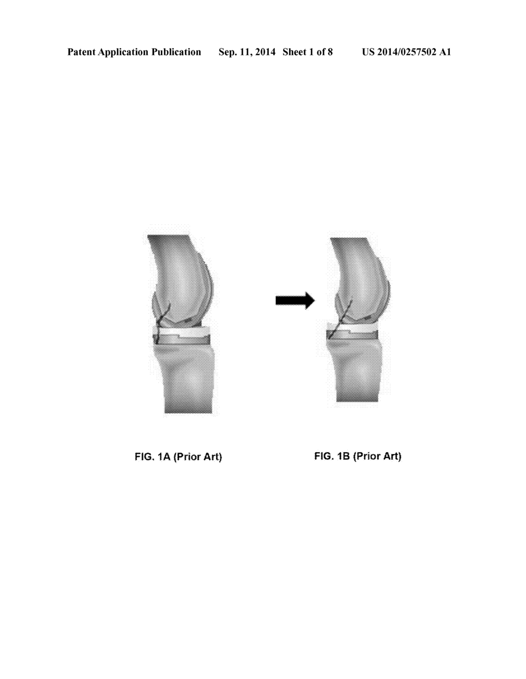 ANTERIOR STABILIZED PCL RETAINING TOTAL KNEE PROSTHESIS - diagram, schematic, and image 02