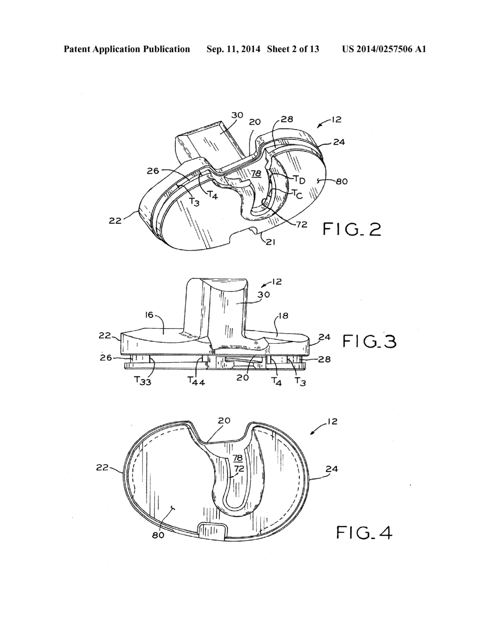 TIBIAL PROSTHESIS - diagram, schematic, and image 03