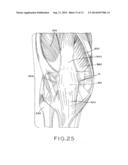 TIBIAL PROSTHESIS diagram and image