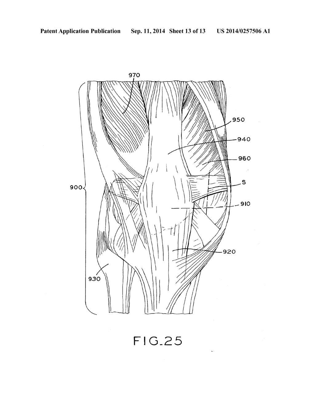 TIBIAL PROSTHESIS - diagram, schematic, and image 14