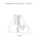 ASPIRATION CATHETERS, SYSTEMS, AND METHODS diagram and image