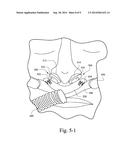 PATIENT INTERFACE SYSTEMS FOR ENSURING EFFECTIVE SEAL diagram and image