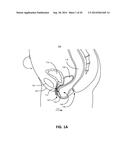 RECTOCELE AND CYSTOCELE DEVICE diagram and image