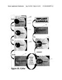 Cannulas, Collars for Implantable Devices, and Corresponding Systems and     Methods diagram and image