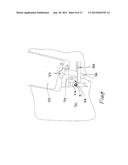 AUTOMATED FRANGIBLE CANNULA BREAKER diagram and image