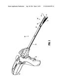 SURGICAL STAPLING APPARATUS diagram and image