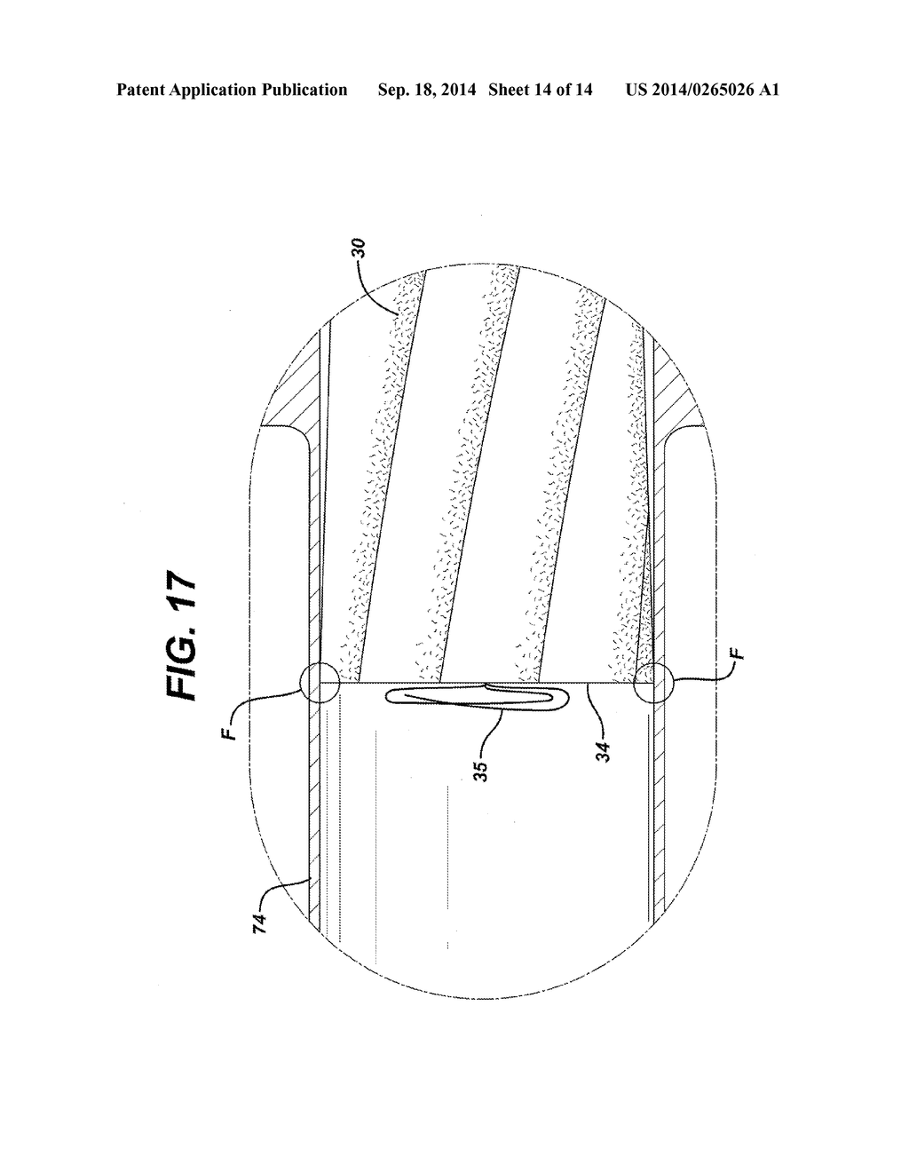 Tampon Having Spirally Shaped Grooves - diagram, schematic, and image 15