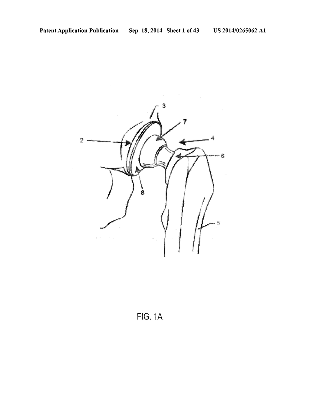 VARIABLE-DENSITY IMPLANTS AND RELATED METHODS AND SYSTEMS - diagram, schematic, and image 02