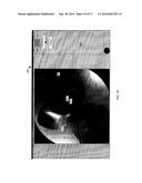 VISUALIZATION GUIDED ACL LOCALIZATION SYSTEM diagram and image