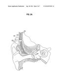 Fitting a Bilateral Hearing Prosthesis System diagram and image