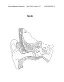 Fitting a Bilateral Hearing Prosthesis System diagram and image