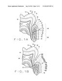 ARTICLE AND METHOD OF INITIATING BONE REGROWTH AND RESTORATION OF GUM     RECESSION WITH LOCALIZED SUBGINGIVAL DELIVERY OF MEDICATIONS diagram and image