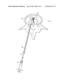 DEVICES CONTAINING A CHEMICAL DENERVATION AGENT AND METHODS FOR TREATING     CHRONIC BACK PAIN USING CHEMICAL DENERVATION diagram and image