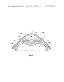 PROSTAMIDE-CONTAINING INTRAOCULAR IMPLANT diagram and image