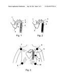 MEDICAL PRODUCT COMPRISING A FUNCTIONAL ELEMENT FOR THE INVASIVE USE IN A     PATIENT  diagram and image