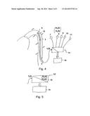 MEDICAL PRODUCT COMPRISING A FUNCTIONAL ELEMENT FOR THE INVASIVE USE IN A     PATIENT  diagram and image