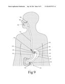 Adjustable Gastrointestinal Bifurcation (AGB) for Reduced Absorption of     Unhealthy Food diagram and image