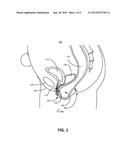 RECTOCELE DEVICE diagram and image