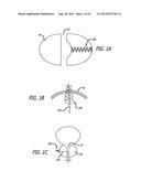 Devices, Systems and Methods for Treating Benign Prostatic Hyperplasia and     Other Conditions diagram and image