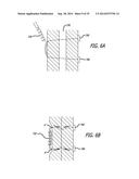 Devices, Systems and Methods for Treating Benign Prostatic Hyperplasia and     Other Conditions diagram and image