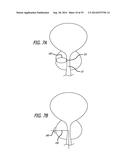 Devices, Systems and Methods for Treating Benign Prostatic Hyperplasia and     Other Conditions diagram and image