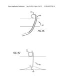 Devices, Systems and Methods for Treating Benign Prostatic Hyperplasia and     Other Conditions diagram and image