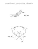 Devices, Systems and Methods for Treating Benign Prostatic Hyperplasia and     Other Conditions diagram and image