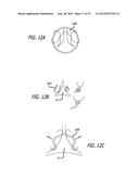 Devices, Systems and Methods for Treating Benign Prostatic Hyperplasia and     Other Conditions diagram and image