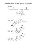 Devices, Systems and Methods for Treating Benign Prostatic Hyperplasia and     Other Conditions diagram and image