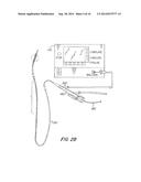 Resector Balloon Catheter With Multi-Port Hub diagram and image