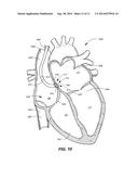 SYSTEMS AND METHODS TO DETERMINE HR, RR AND CLASSIFY CARDIAC RHYTHMS BASED     ON ATRIAL IEGM AND ATRIAL PRESSURE SIGNALS diagram and image