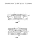 Side Lumen Reentry Catheters And Related Methods diagram and image