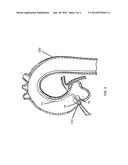 DELIVERY CATHETER HAVING EXPANDABLE ELEMENTS diagram and image