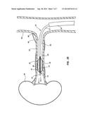 QUANTIFICATION OF RENAL DENERVATION VIA ALTERATIONS IN RENAL BLOOD FLOW     PRE/POST ABLATION diagram and image